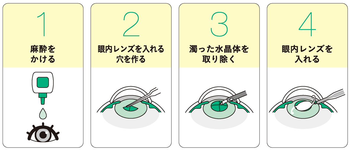 白内障手術とは