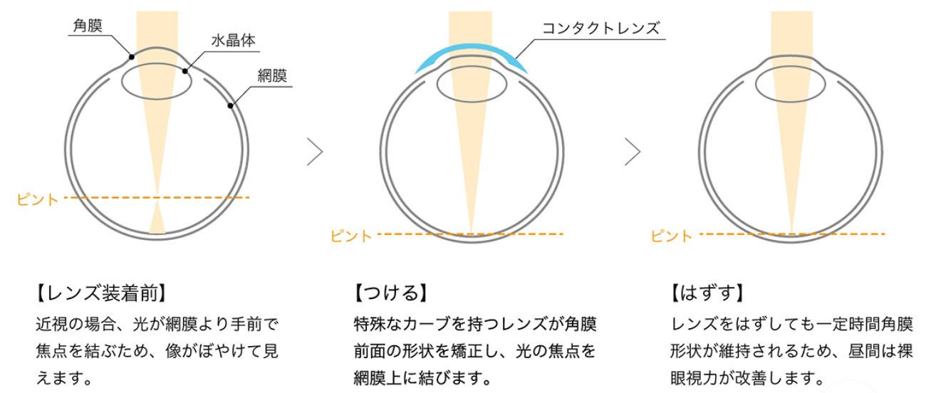 オルソケラトロジーの仕組み